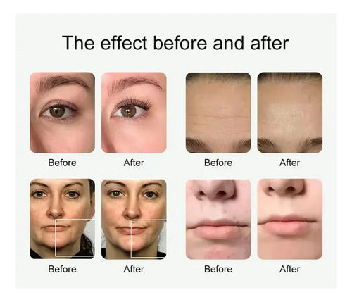 Máquina Facial 10 en 1 Pro — Hidrodermoabrasión, Ultrasonido y RF