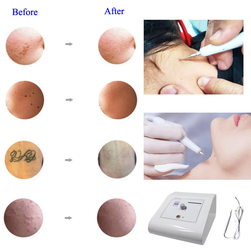 Electrocauterio Profesional para Eliminación de verrugas, nevus, lunares, tatuaje.